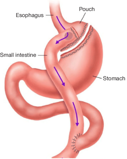 Gastric bypass Dubai